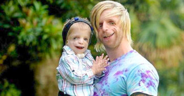 Este hombre con una rara enfermedad, viajó hasta Australia para conocer a un niño con el mismo Síndrome