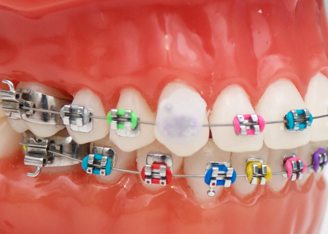 20 cosas que quienes crecieron con brackets entenderán