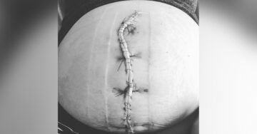 Mamá comparte fotografía de su gigantesca cicatriz de cesárea para darle una lección al mundo entero