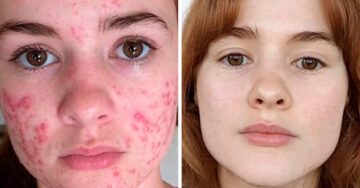 Chica comparte su lucha contra el acné; una historia de autoestima que está inspirando a Internet