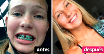 20 Tuiteros comparten su increíble cambio en un antes vs. después de usar brackets