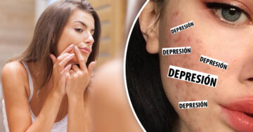 ¡Alerta ‘skin care’! El estrés, la ansiedad y la depresión podrían estar causando tu acné