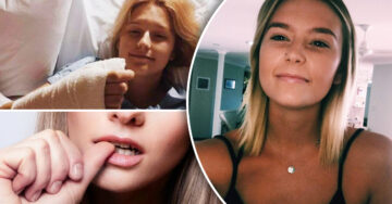 Tras años y años de morderse las uñas, una adolescente desarrolla un extraño cáncer en la piel