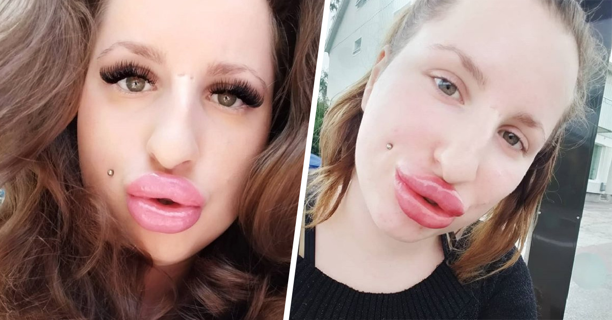 Obsesionada Con Labios Gruesos Gasta Miles En Rellenarlos