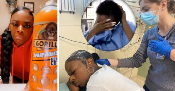 Operan a mujer que usó Gorilla Glue en el cabello y así fue el resultado
