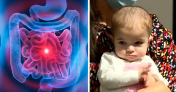 Bebé de 13 meses recibe en Madrid un trasplante intestinal único en el mundo