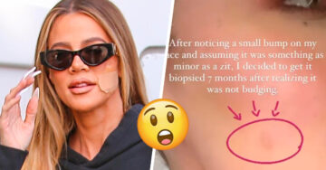 Khloé Kardashian habla sobre su ‘curita’ en el rostro y  revela que le extirparon un tumor